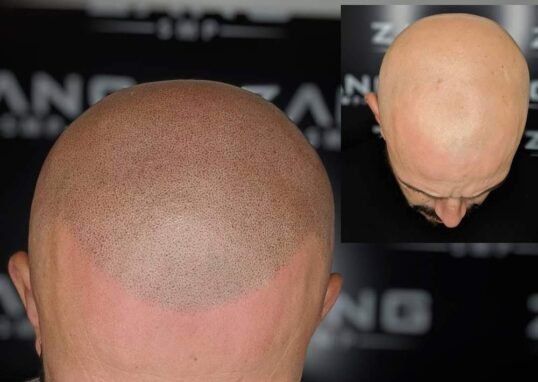 What Makes a Good Scalp Micropigmentation Artist