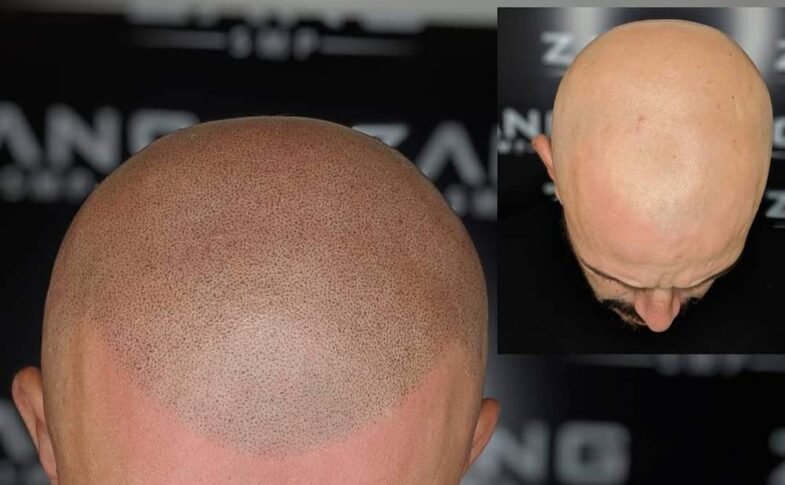 What Makes a Good Scalp Micropigmentation Artist