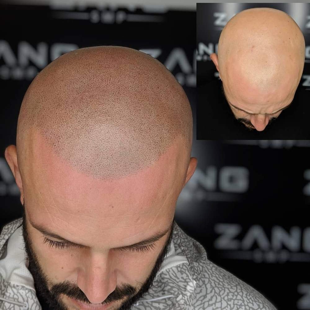 What Makes a Good Scalp Micropigmentation Artist